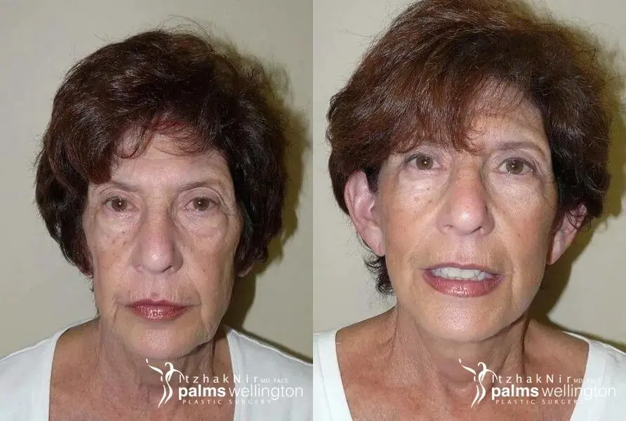 Facelift | Royal Palm Beach - Before and After