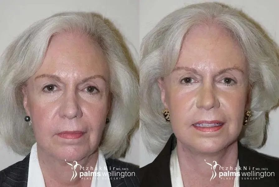 Facelift | Palm Beach Gardens - Before and After
