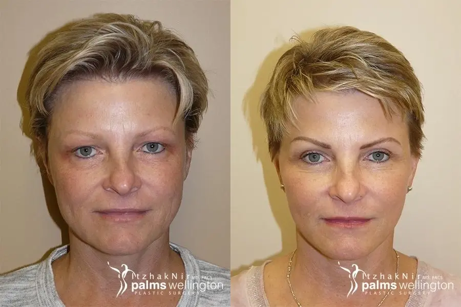 Facelift | West Palm Beach - Before and After