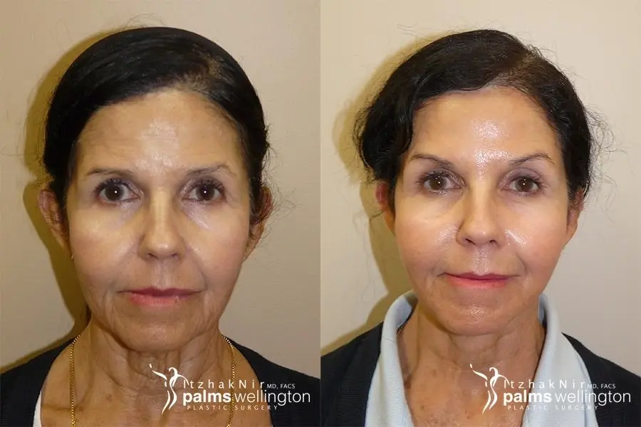 Facelift | Boynton Beach - Before and After