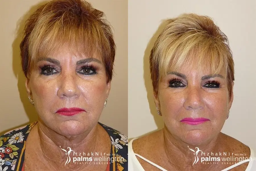Facelift | Boca Raton - Before and After