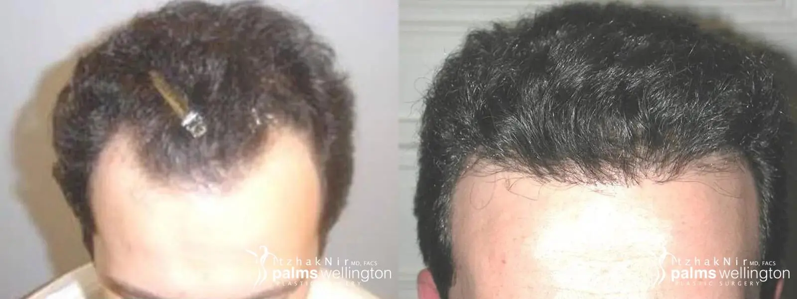 Hair Restoration | Boynton Beach - Before and After