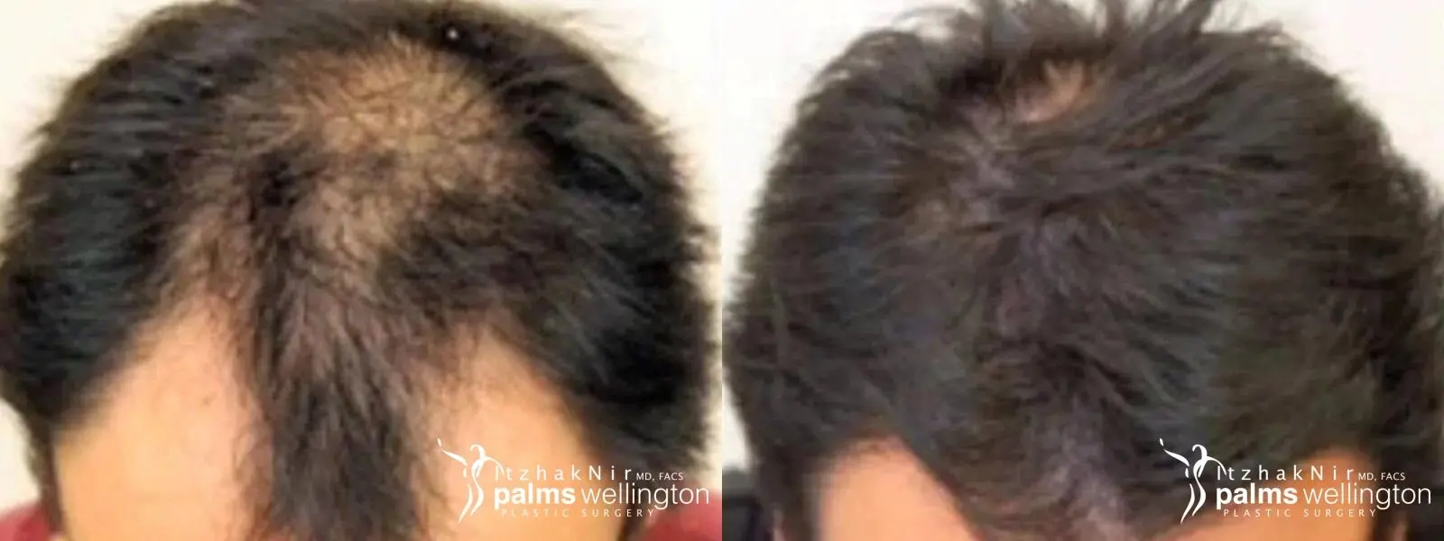 Hair Restoration | Boca Raton - Before and After