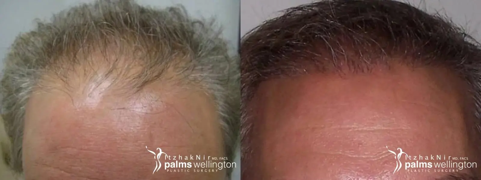 Hair Restoration| Wellington - Before and After