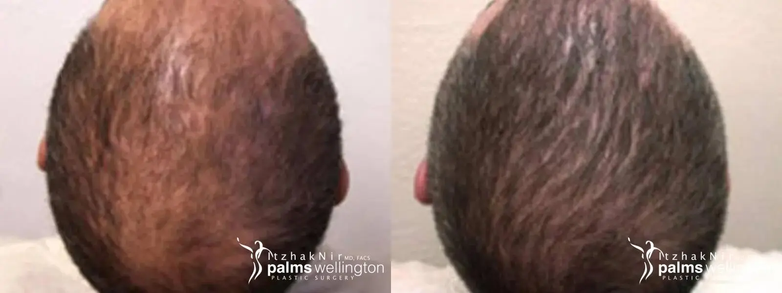 Hair Restoration | Delray Beach - Before and After