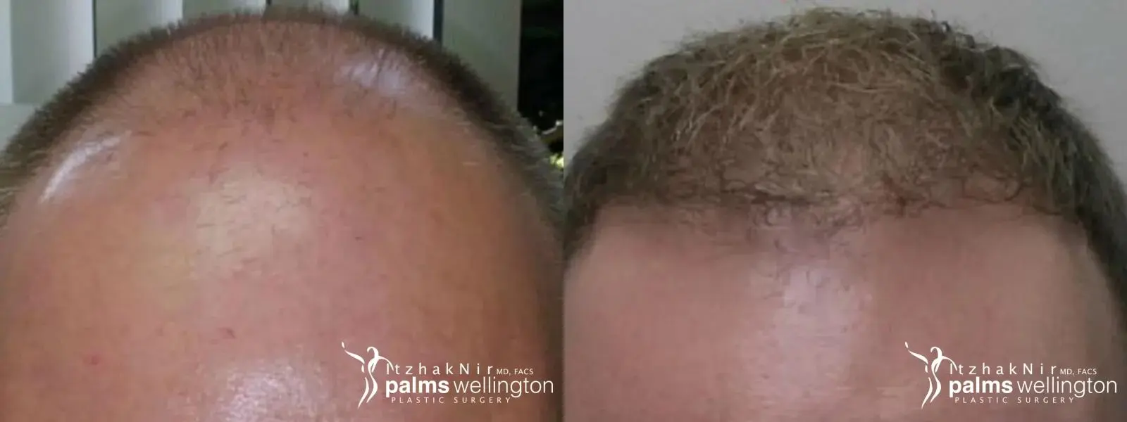 Hair Restoration | Palm Beach Gardens - Before and After