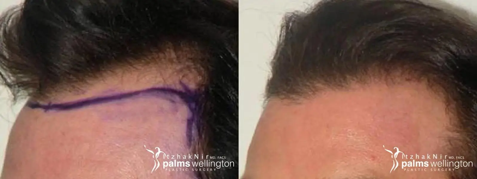 Hair Restoration| Jupiter - Before and After