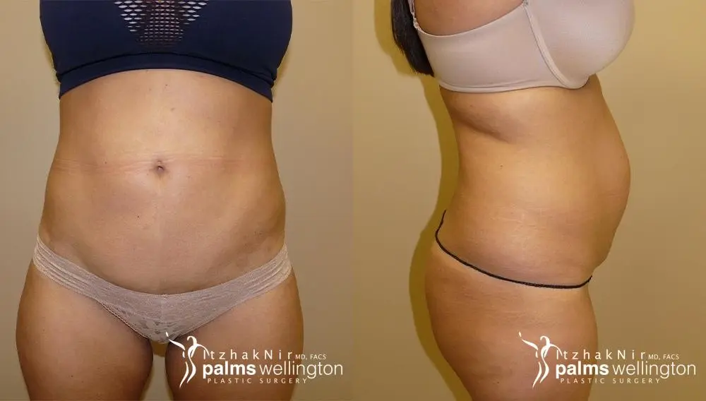 Liposuction | Delray Beach - Before and After