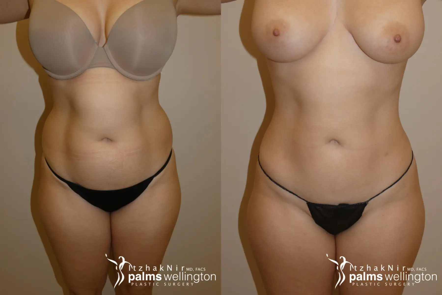 Liposuction | West Palm Beach - Before and After