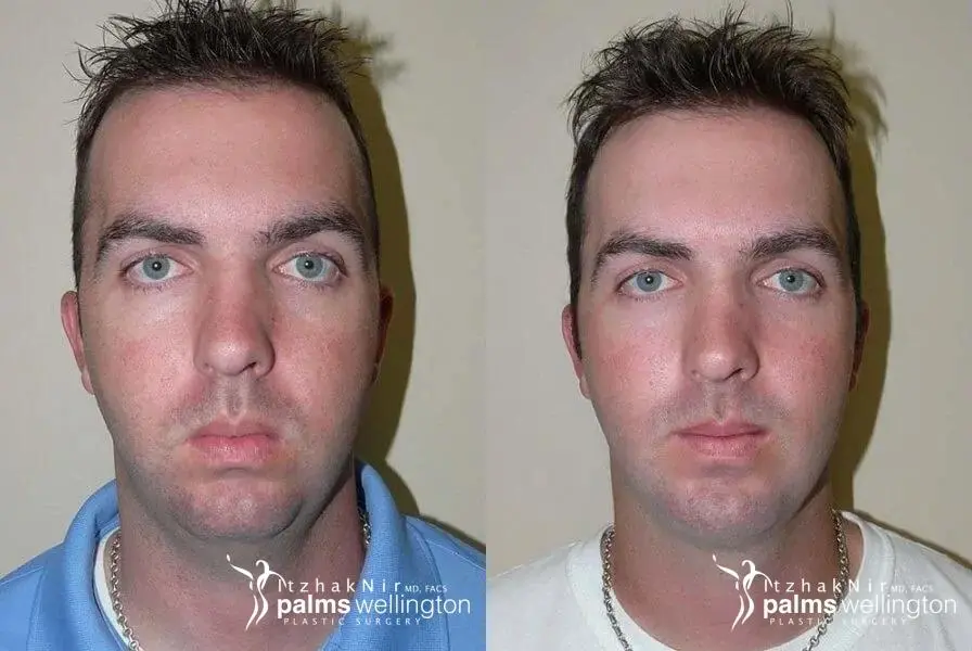 Neck Contouring WestPalmBeach - Before and After