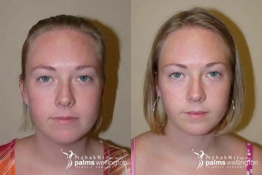 Neck Contouring: Case 1 - Before and After  