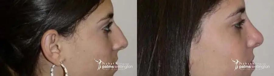 Non-Surgical Nose Job Specialist in Verona, NJ