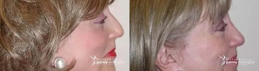 Rhinoplasty | Delray Beach - Before and After