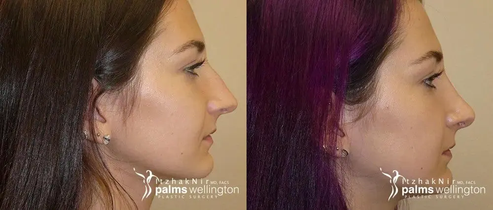 Rhinoplasty | West Palm Beach - Before and After