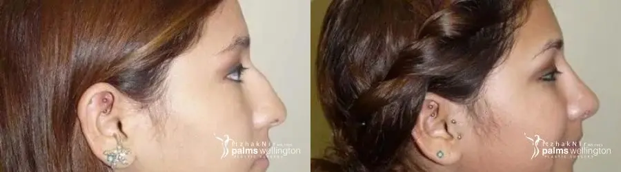 Rhinoplasty | Boca Raton - Before and After