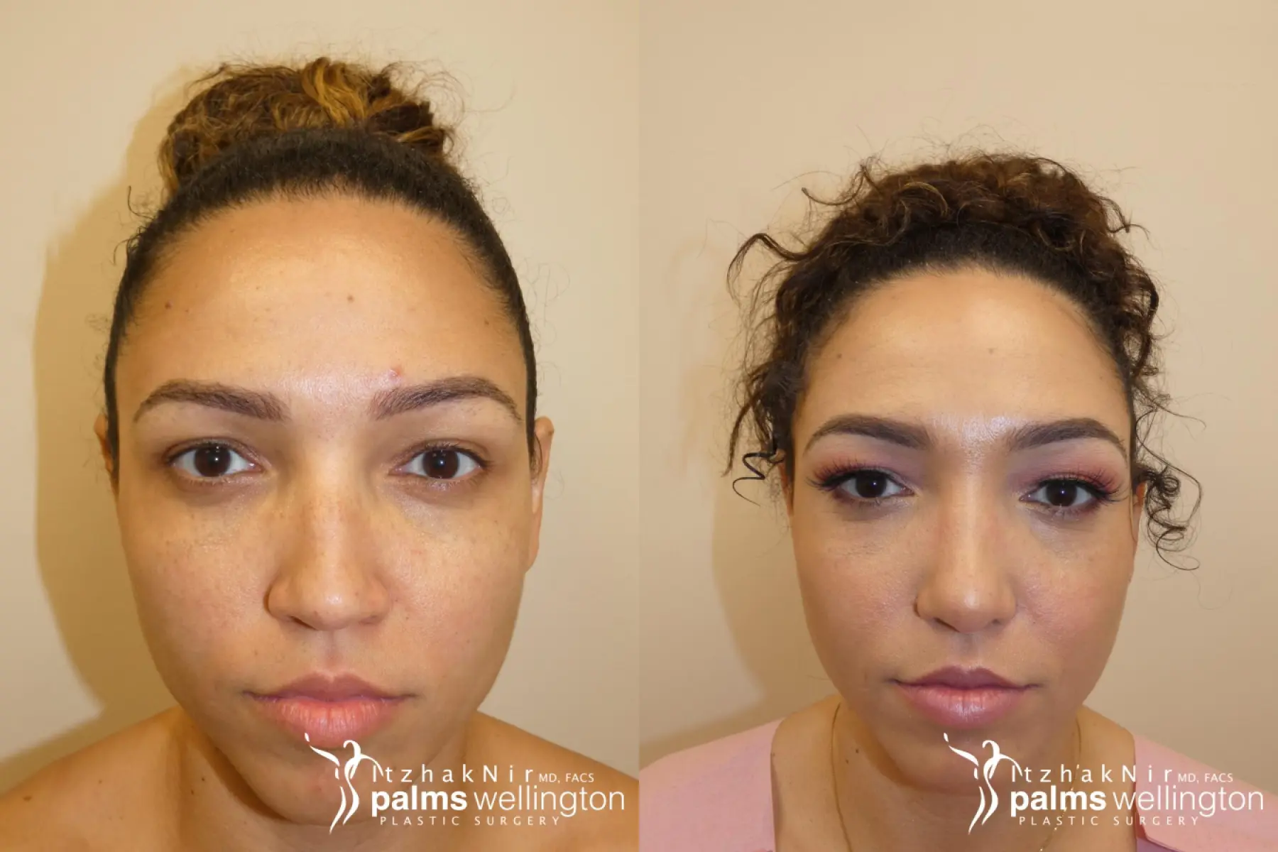 Rhinoplasty | Palm Beach - Before and After