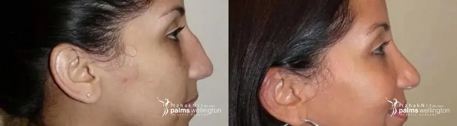 Rhinoplasty | Boca Raton - Before and After