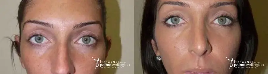 Rhinoplasty | West Palm Beach - Before and After