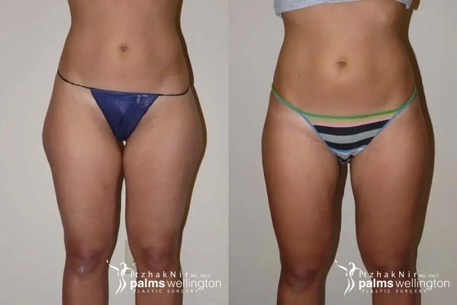 Thigh Lift: Case 1 - Before and After  