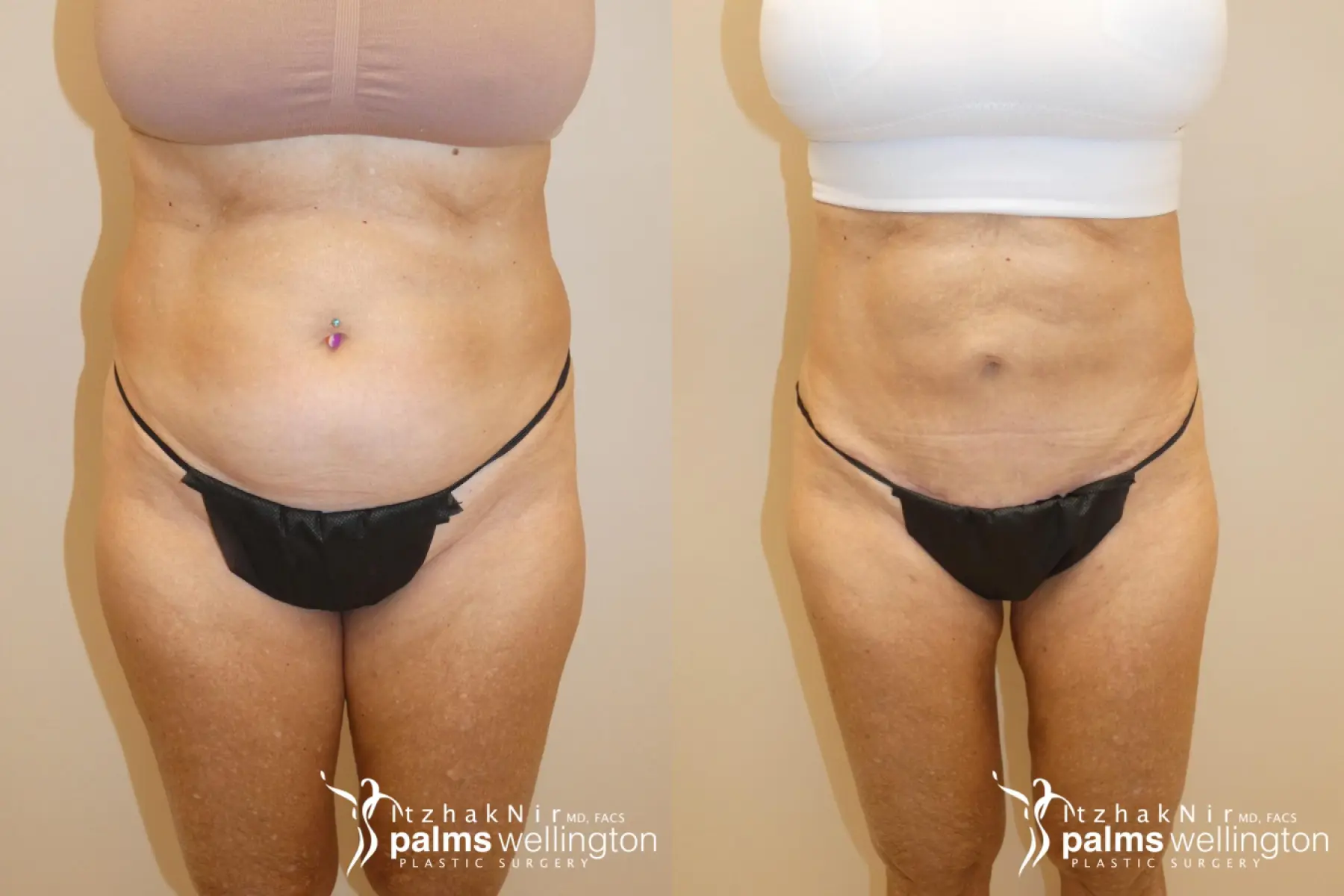 Thigh Lift WestPalmBeach - Before and After