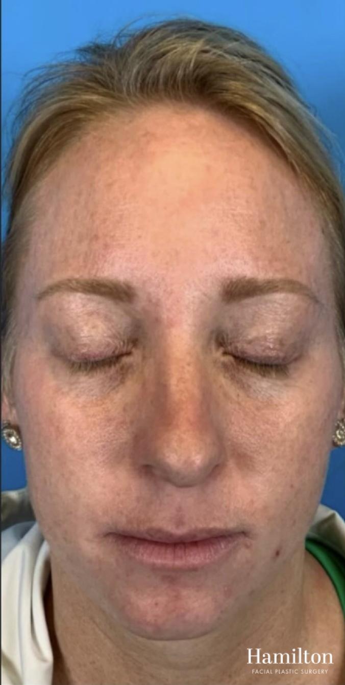 MOXI Laser: Patient 2 - Before 