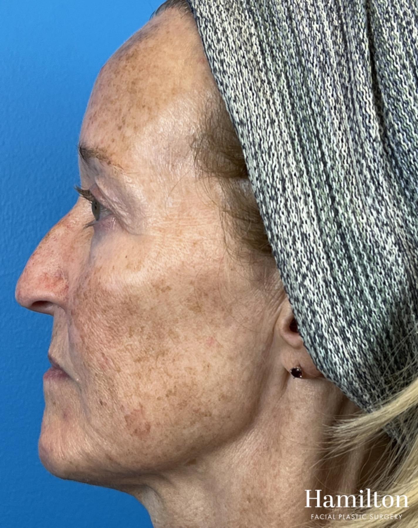 HALO Laser: Patient 2 - Before 
