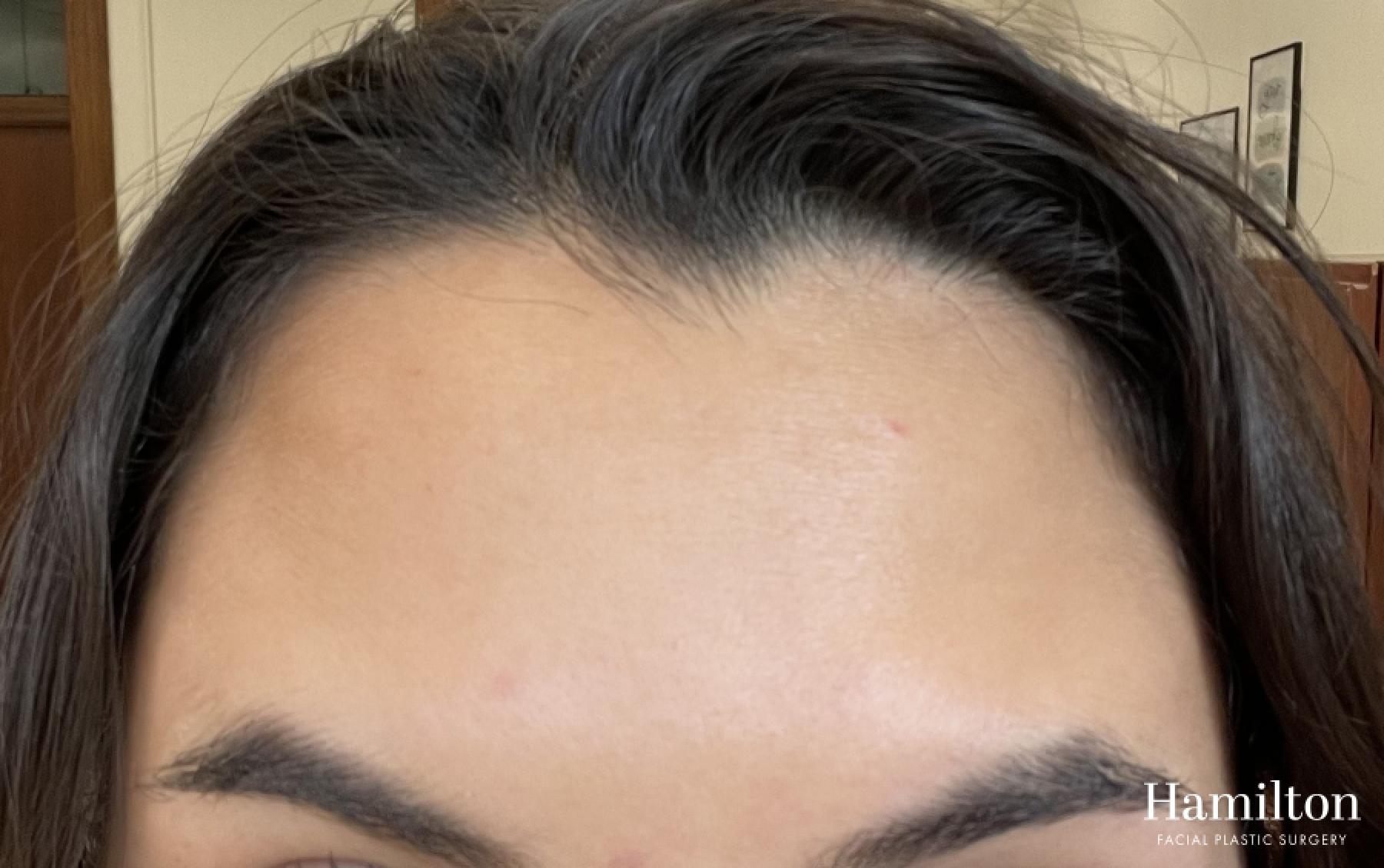 Neurotoxins/Botox: Patient 10 - After  
