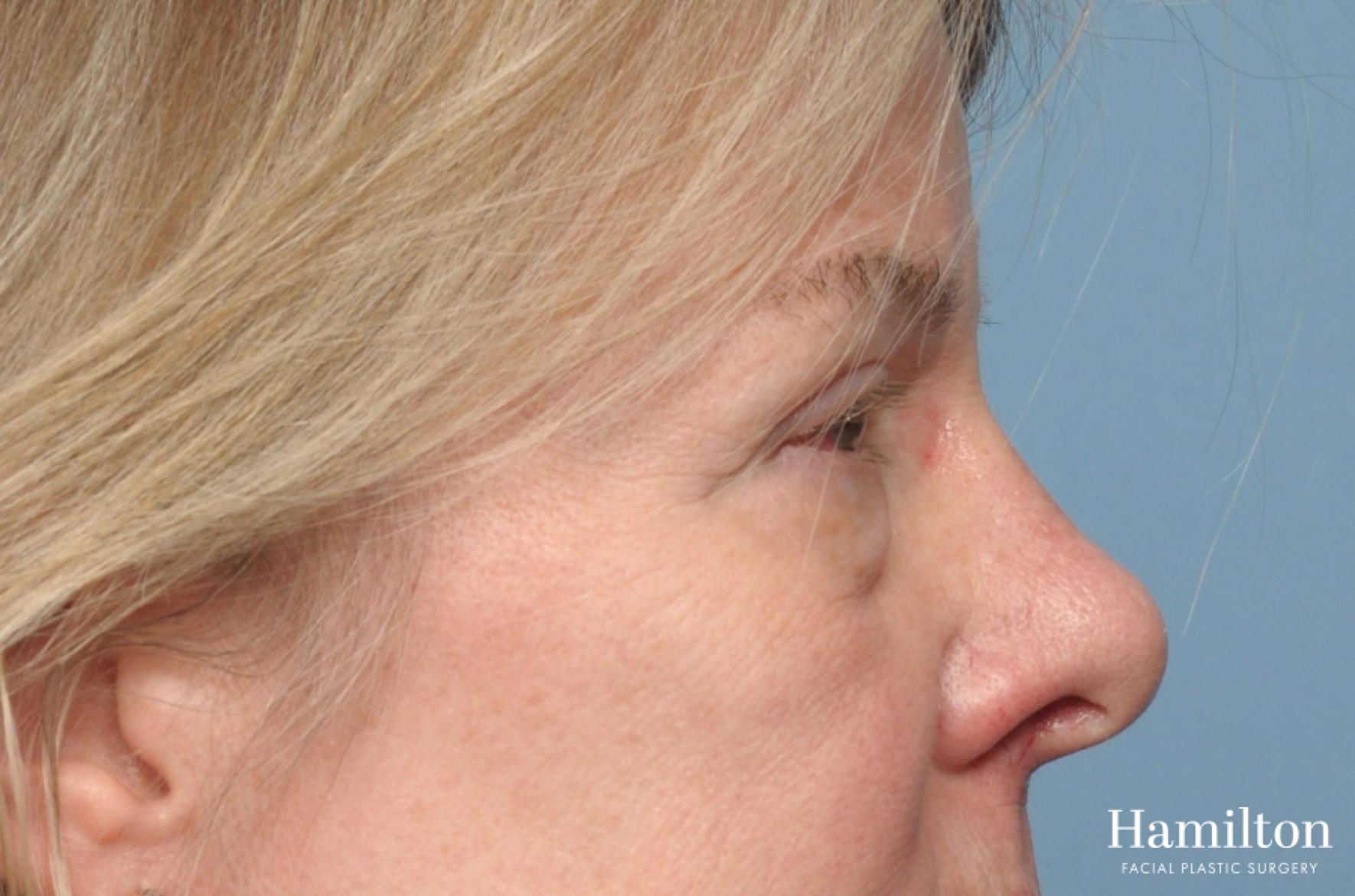 Blepharoplasty: Patient 11 - Before 2