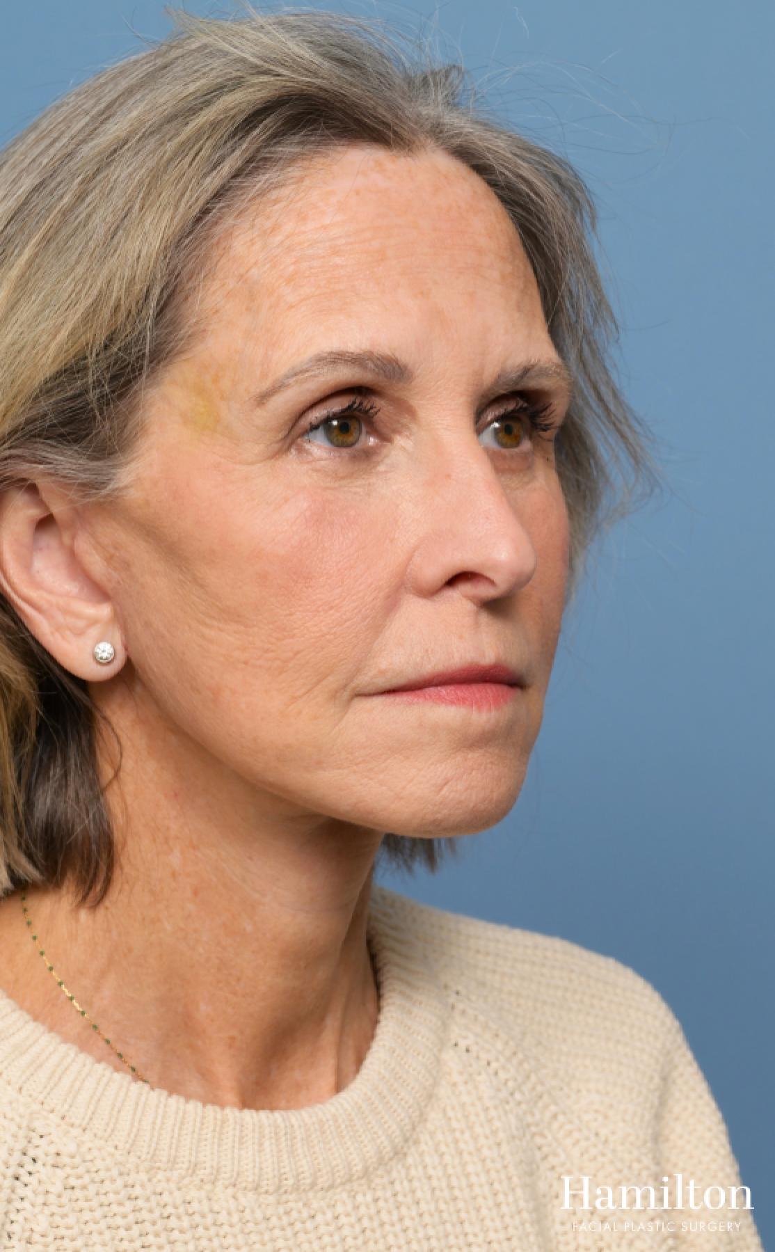 Fat Grafting: Patient 1 - After 2