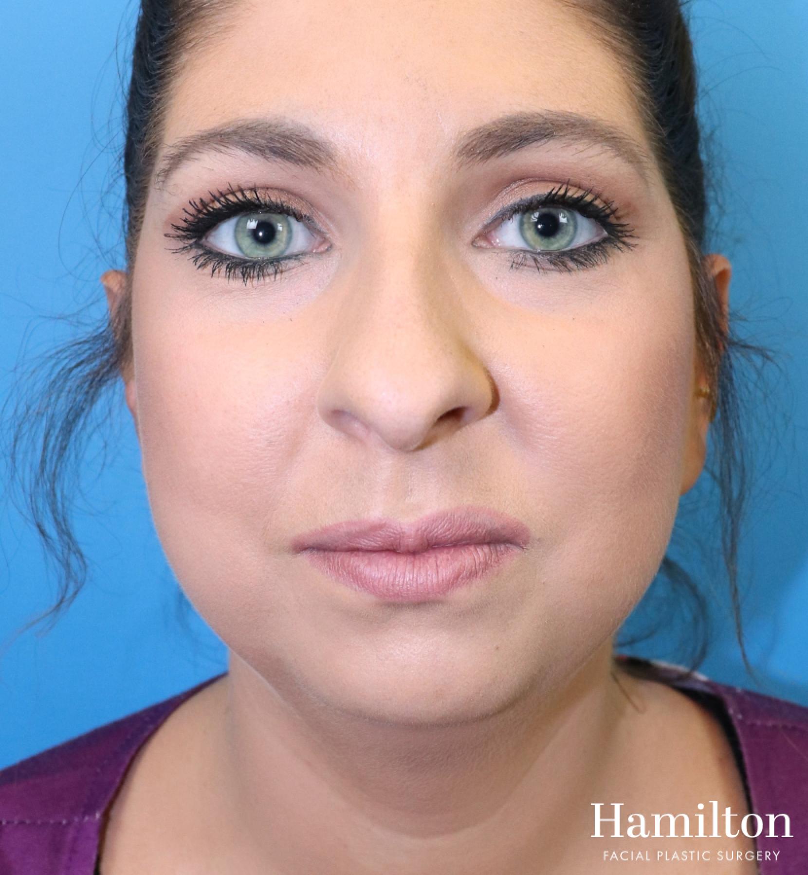 Chin Augmentation: Patient 10 - Before 4
