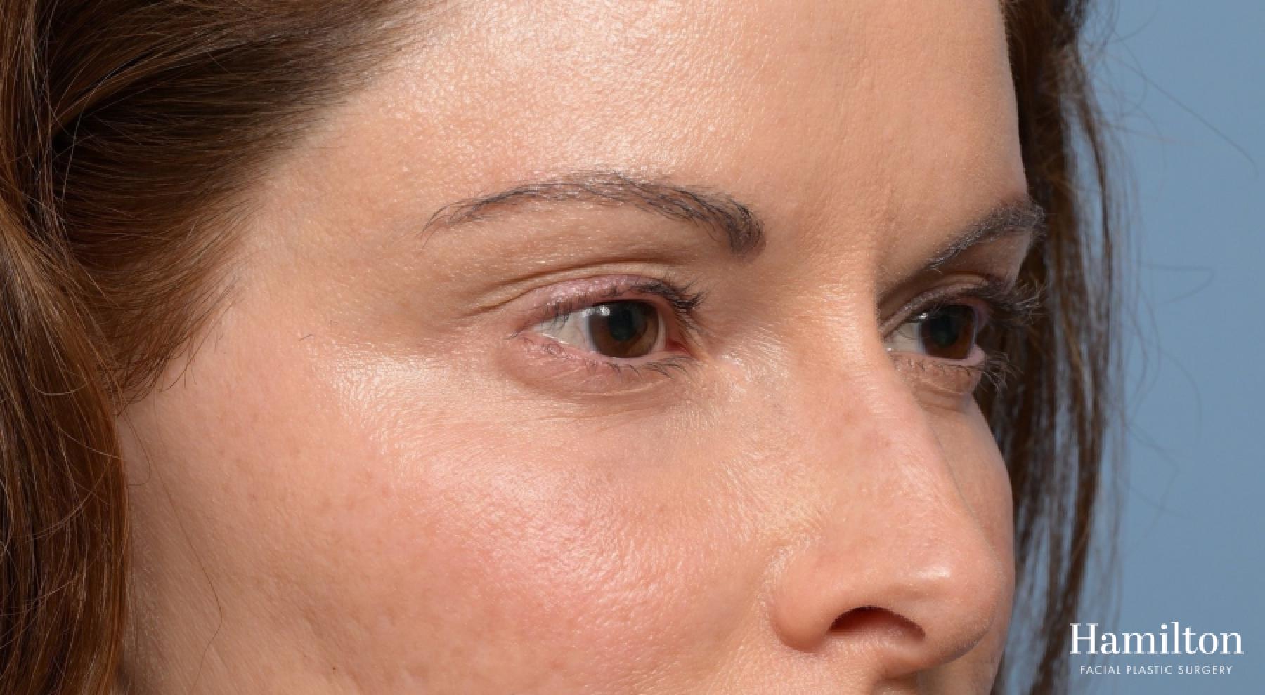 Blepharoplasty: Patient 6 - Before 2