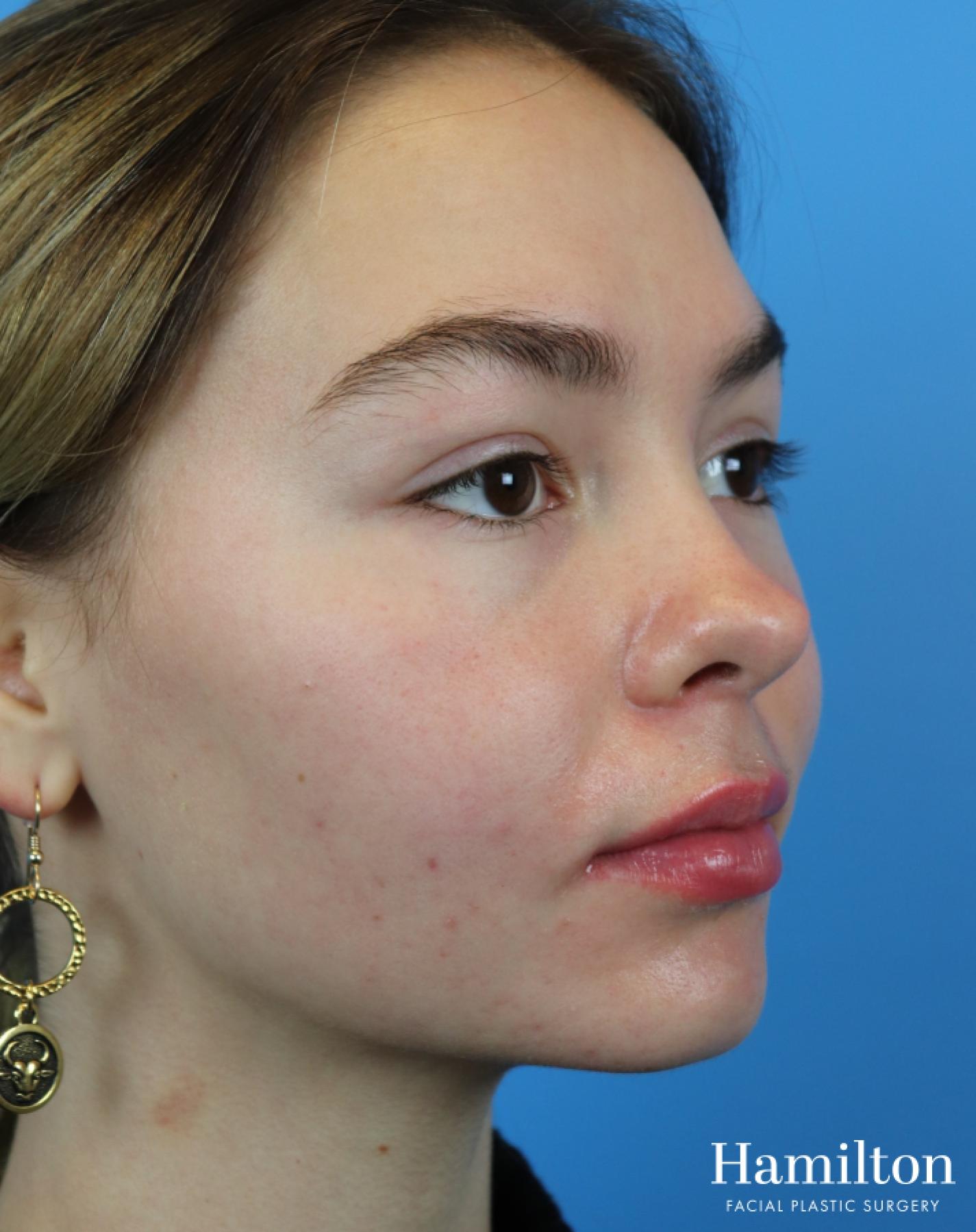 Lip Enhancement: Patient 2 - After 4