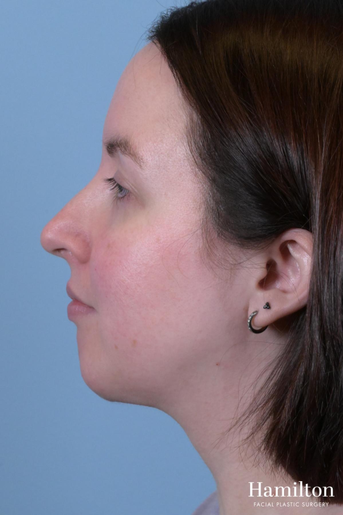 Submentoplasty/Deep Neck Lift: Patient 1 - After