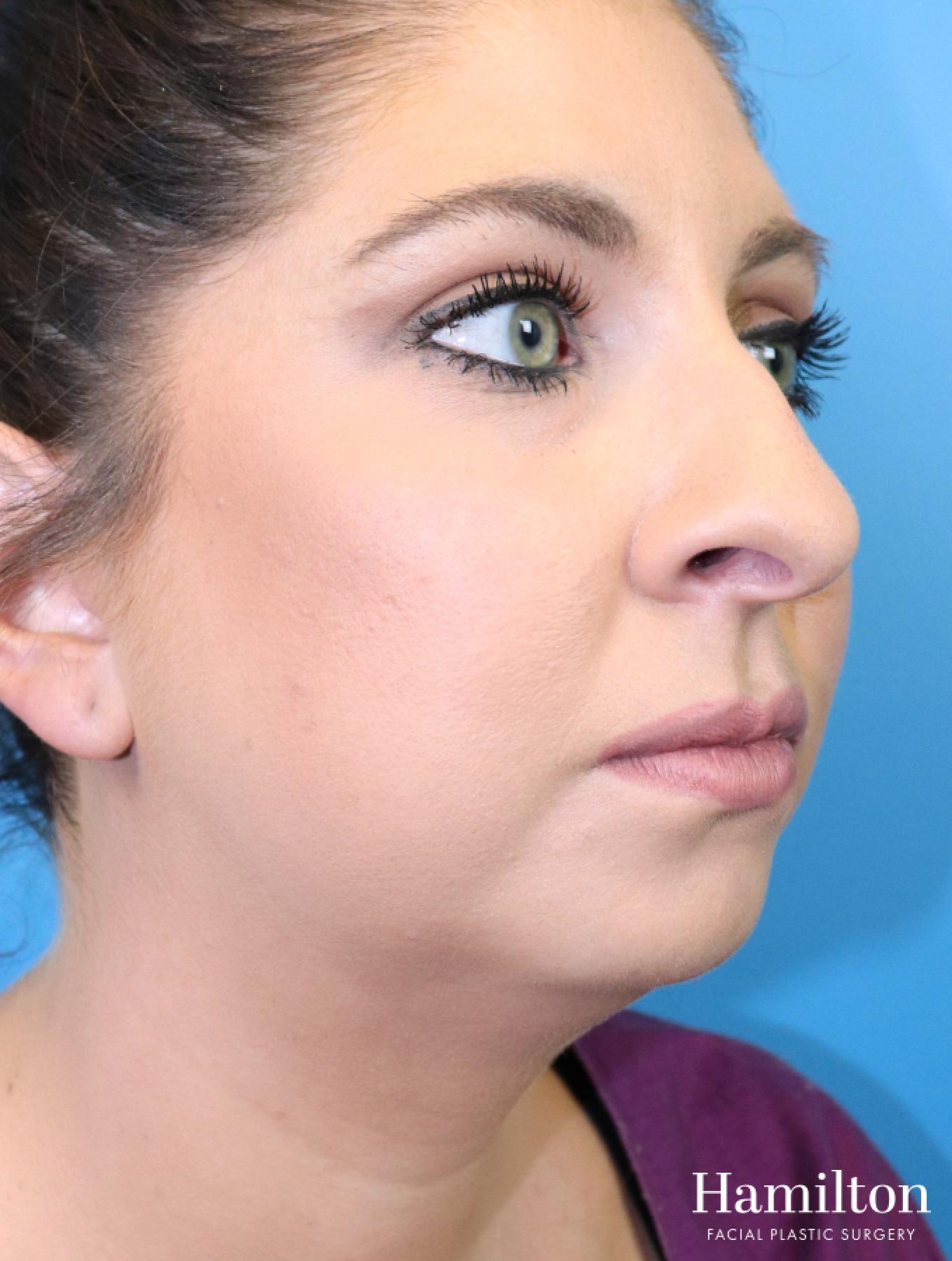 Chin Augmentation: Patient 10 - Before 3