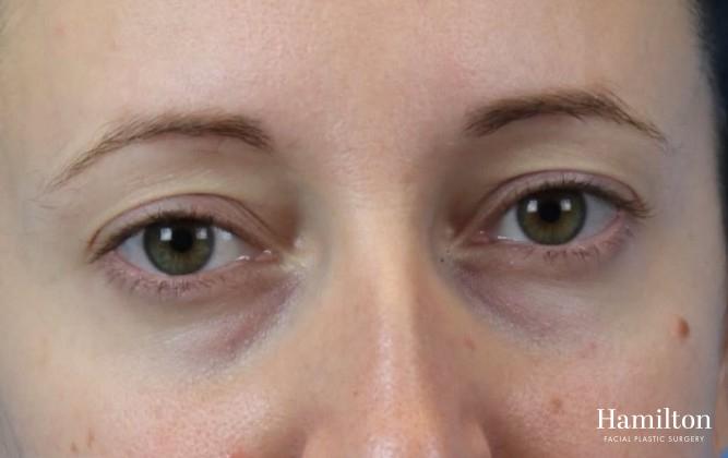 Fillers: Patient 6 - Before 