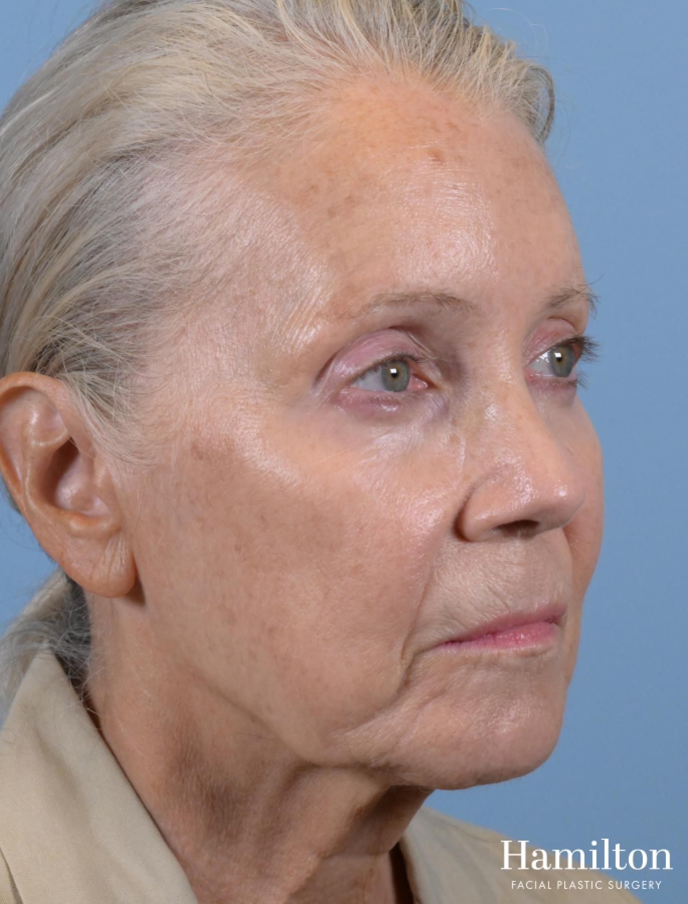 Facelift: Patient 3 - Before 2