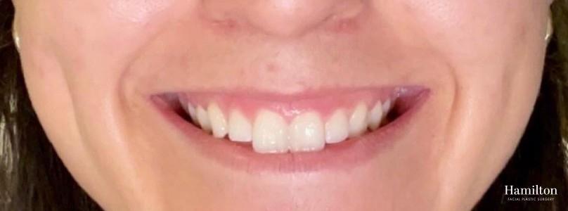 BOTOX® Cosmetic: Patient 6 - Before 1