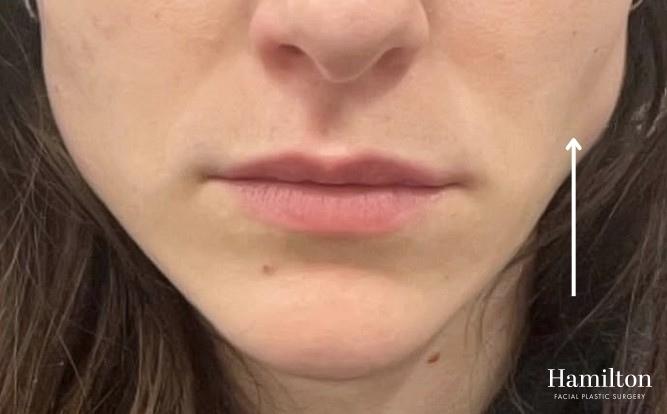 BOTOX® Cosmetic: Patient 12 - Before 1