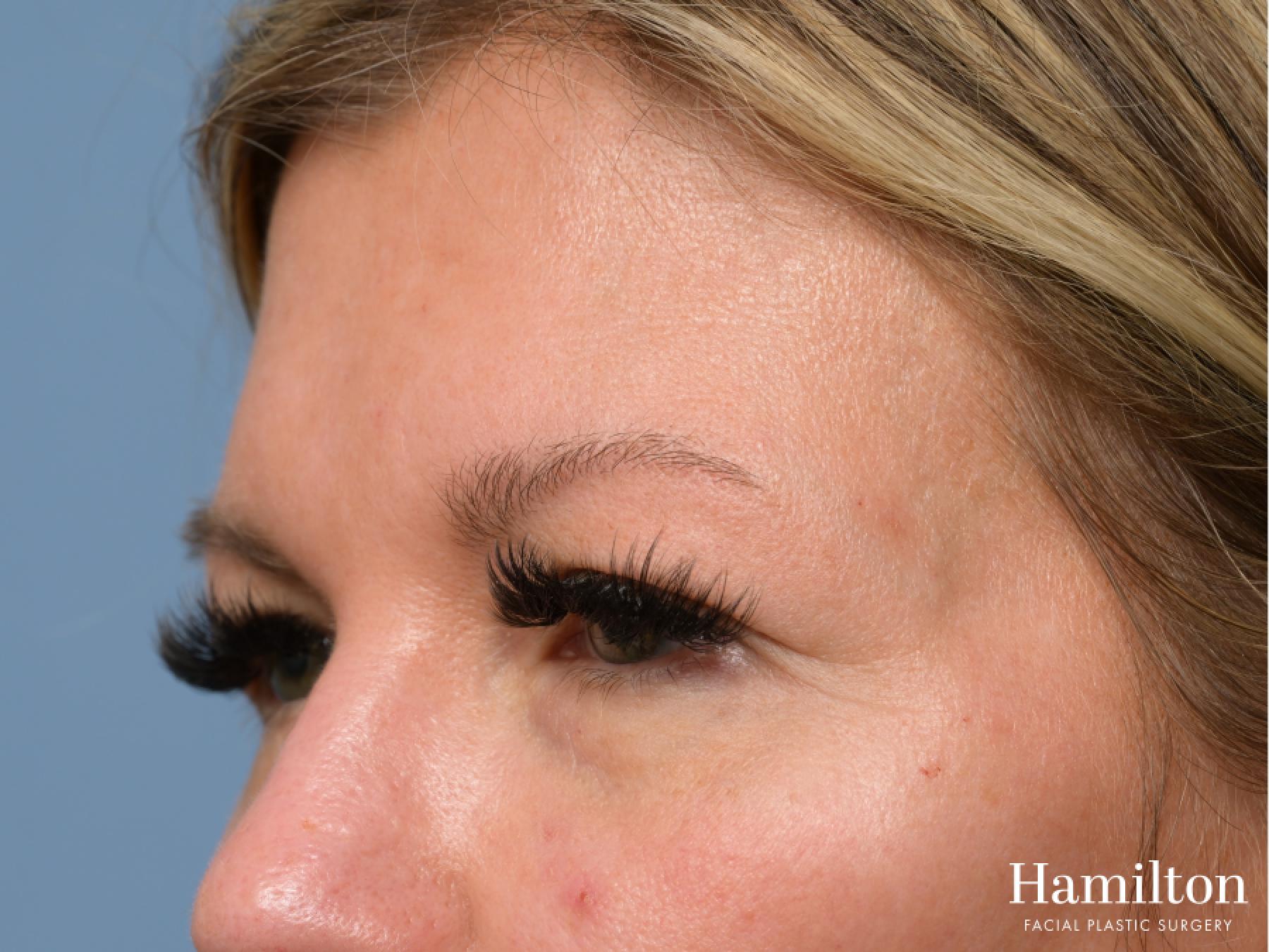 Blepharoplasty: Patient 4 - Before 3