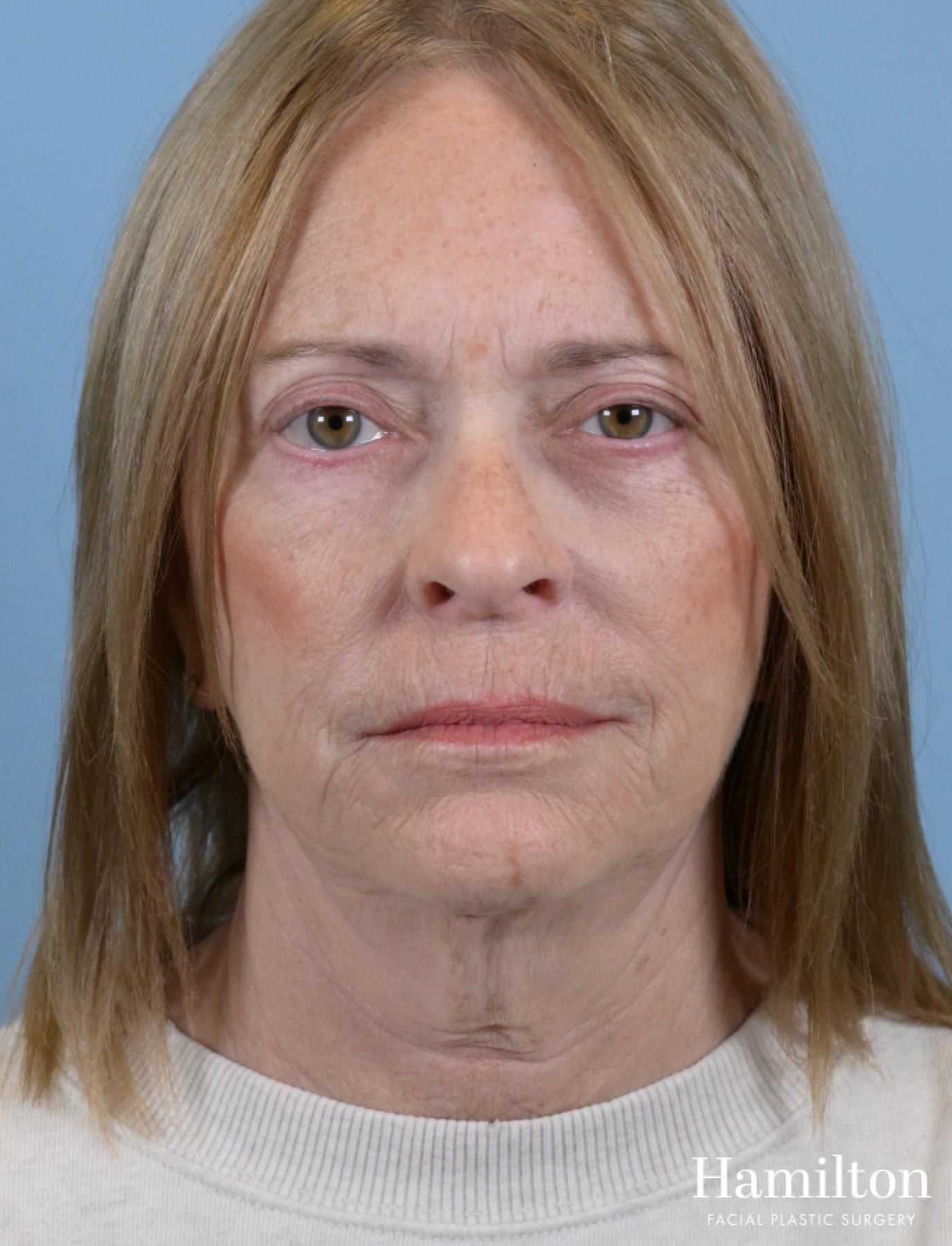 Sciton Laser: Patient 2 - Before 1