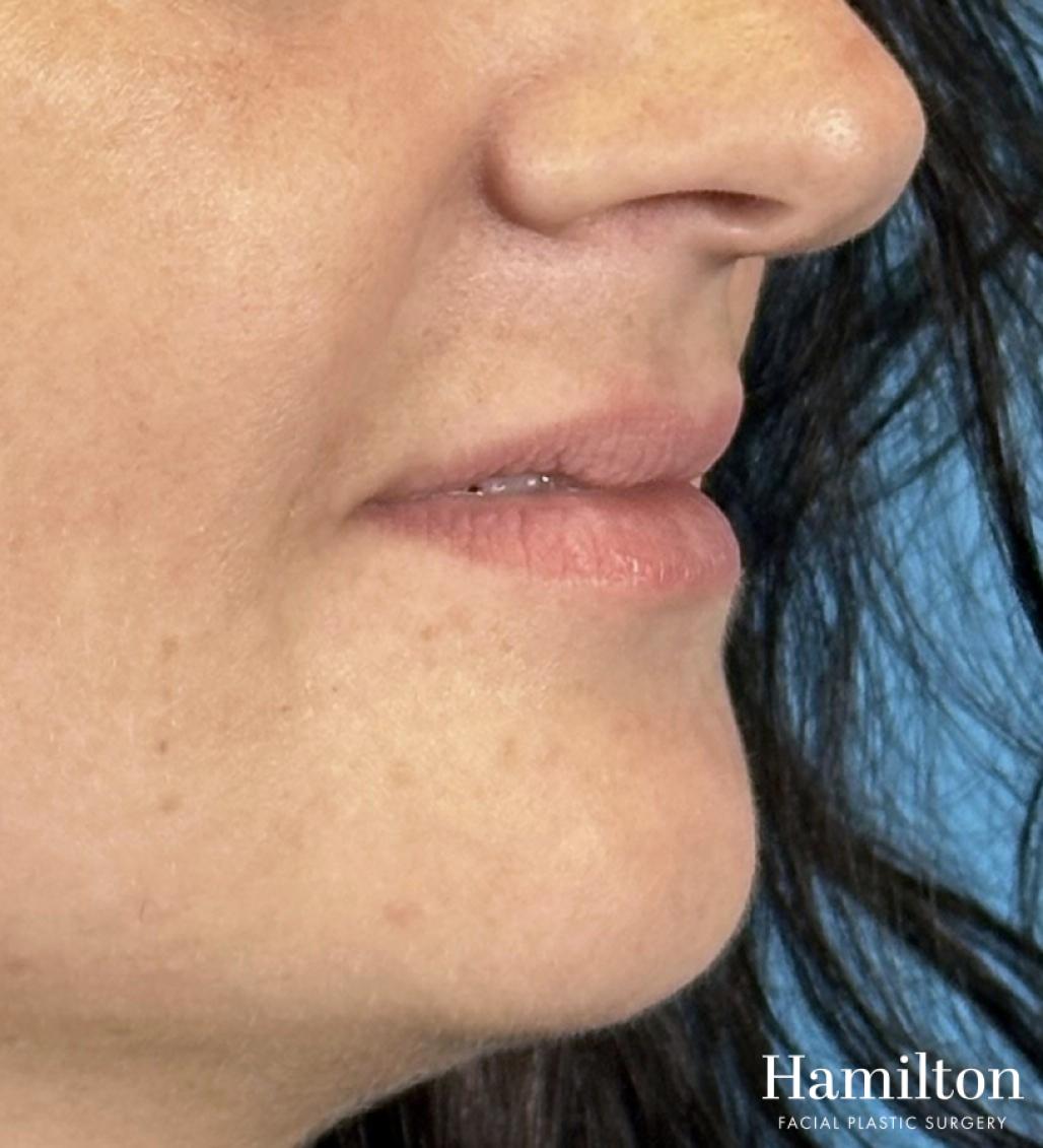 Fillers: Patient 4 - Before 