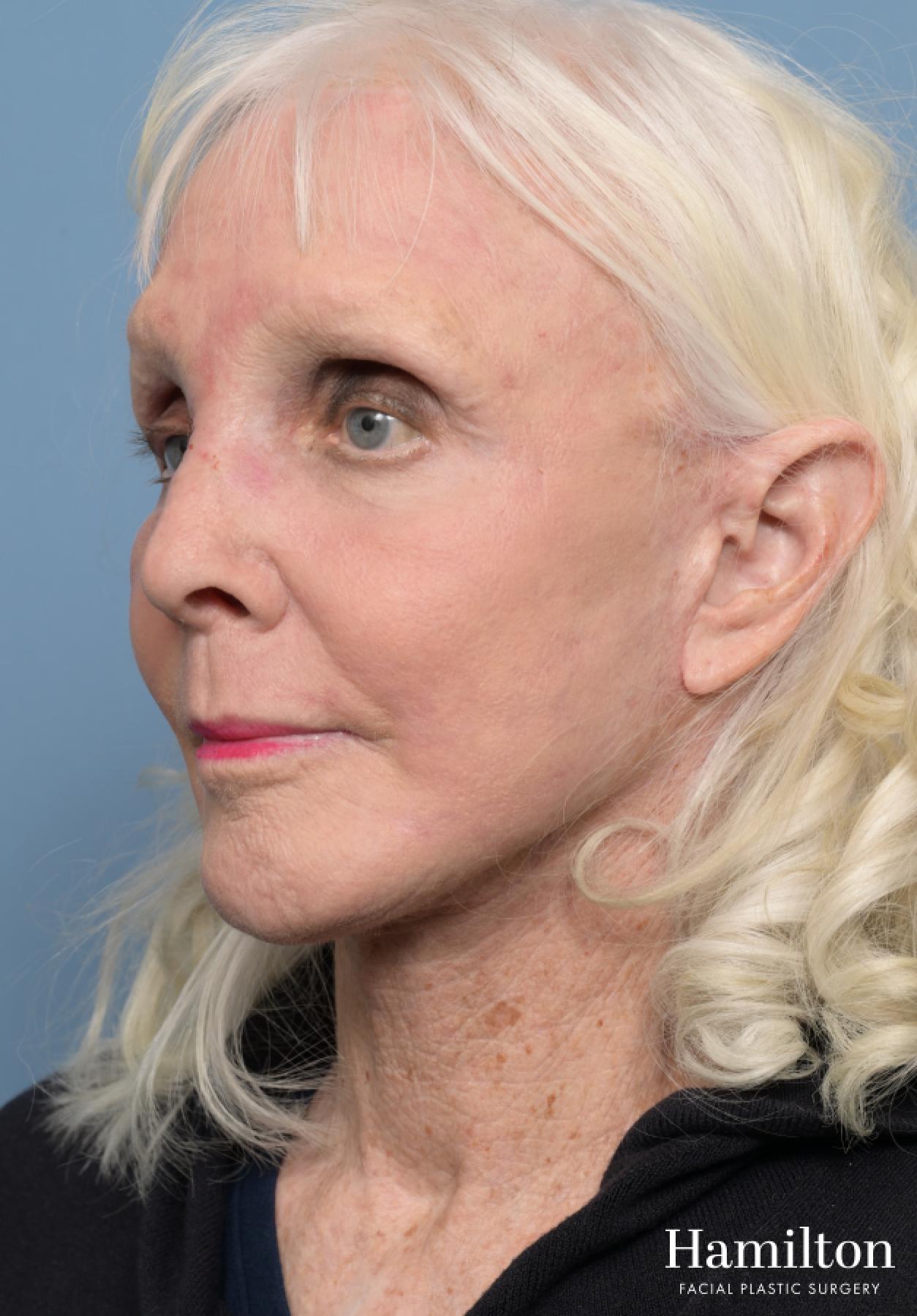 C02 Laser: Patient 7 - After