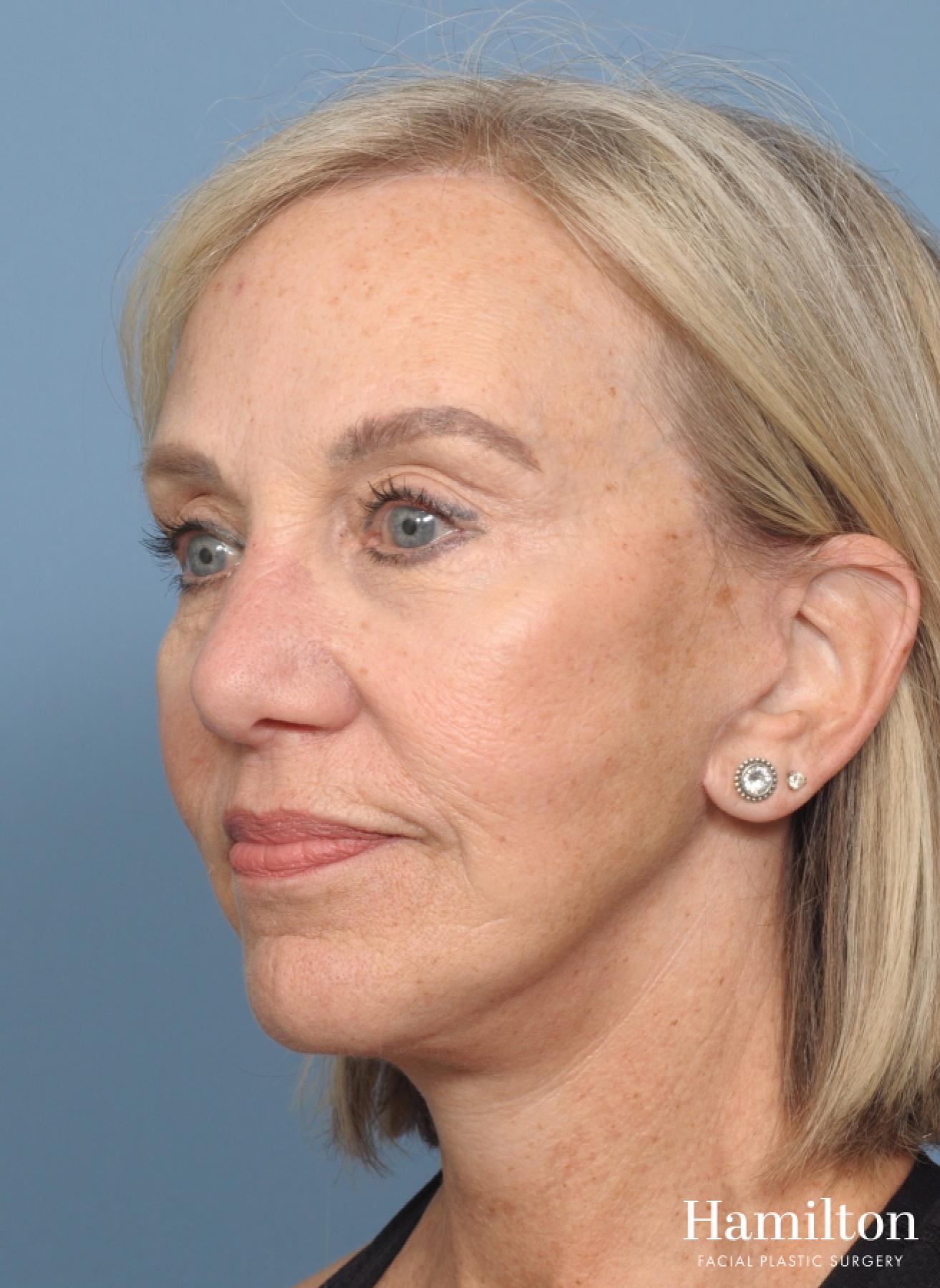 Mini Facelift: Patient 1 - After 5