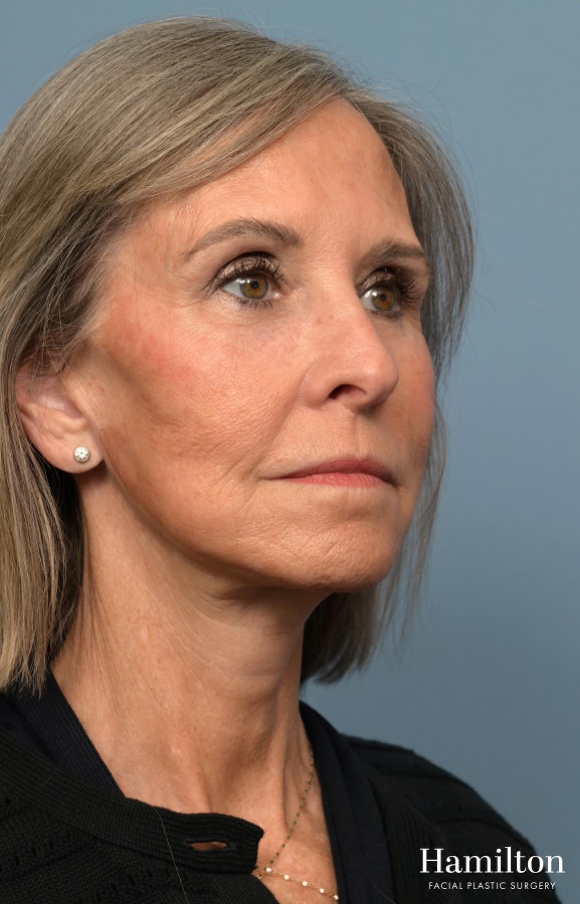 Fat Grafting: Patient 1 - After 2_2