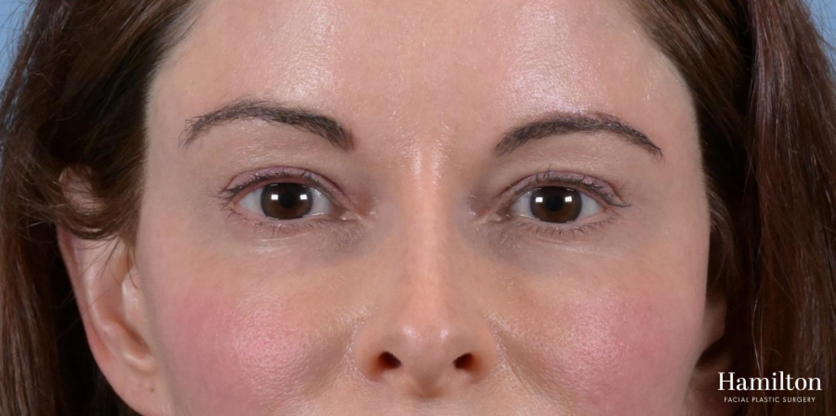 Blepharoplasty: Patient 6 - After 4