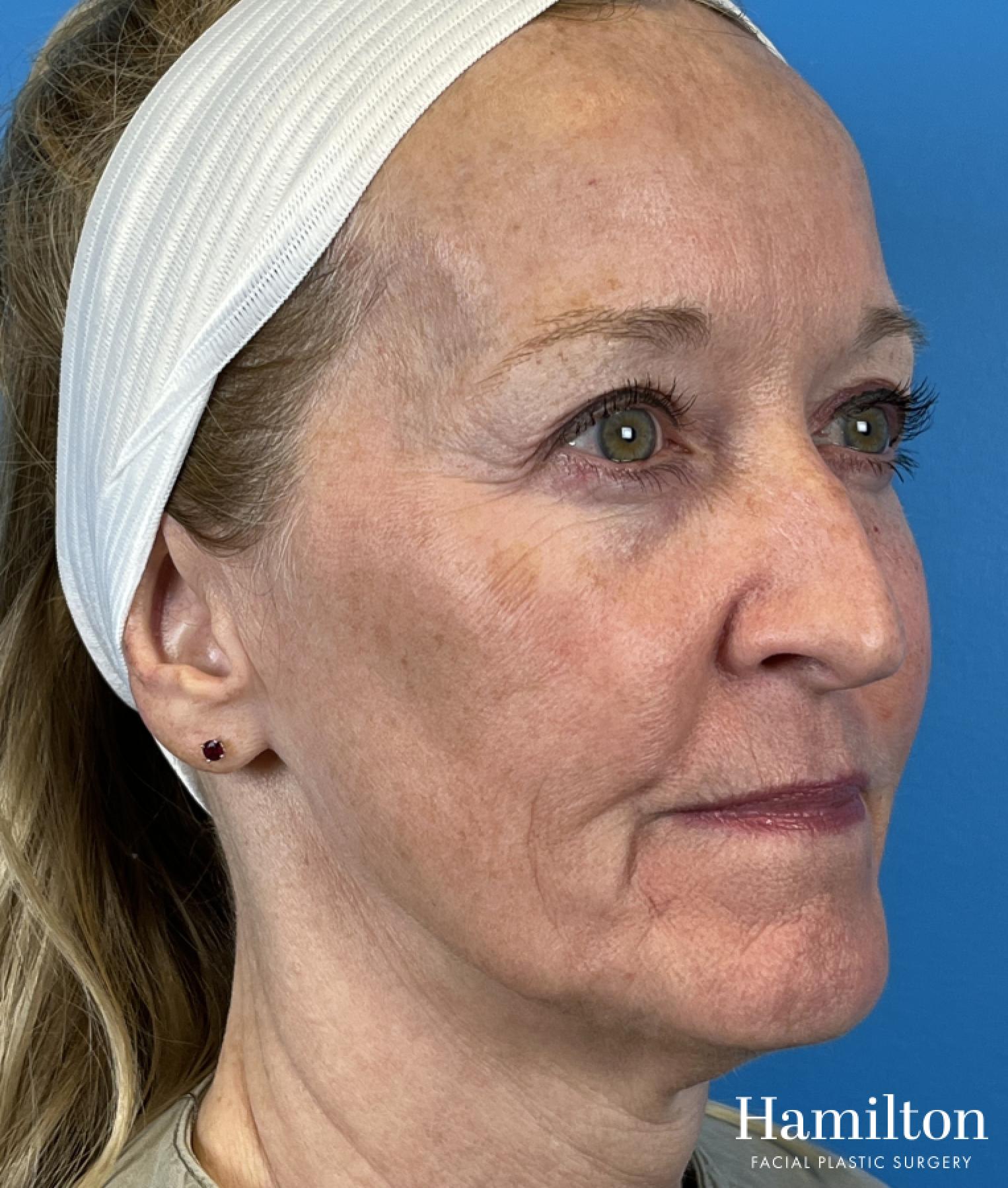Broad Band Light (BBL): Patient 1 - After 5