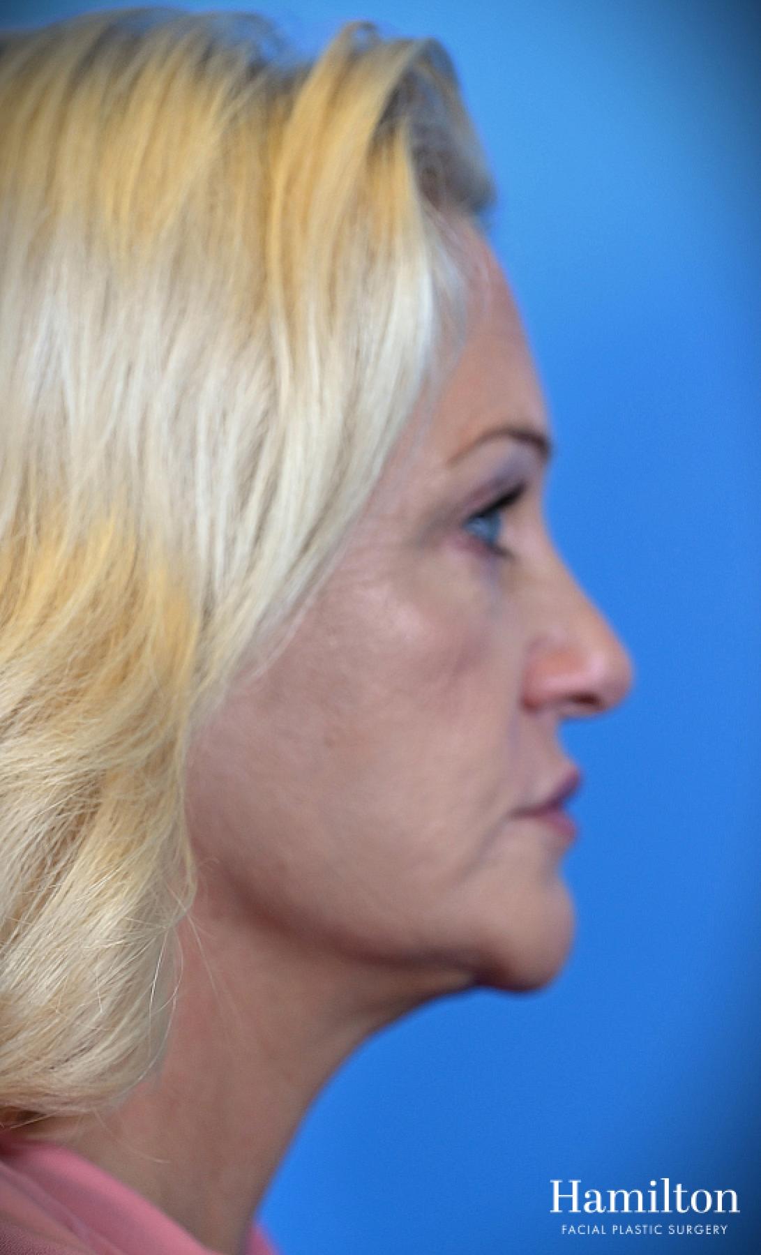 Fillers: Patient 8 - Before 