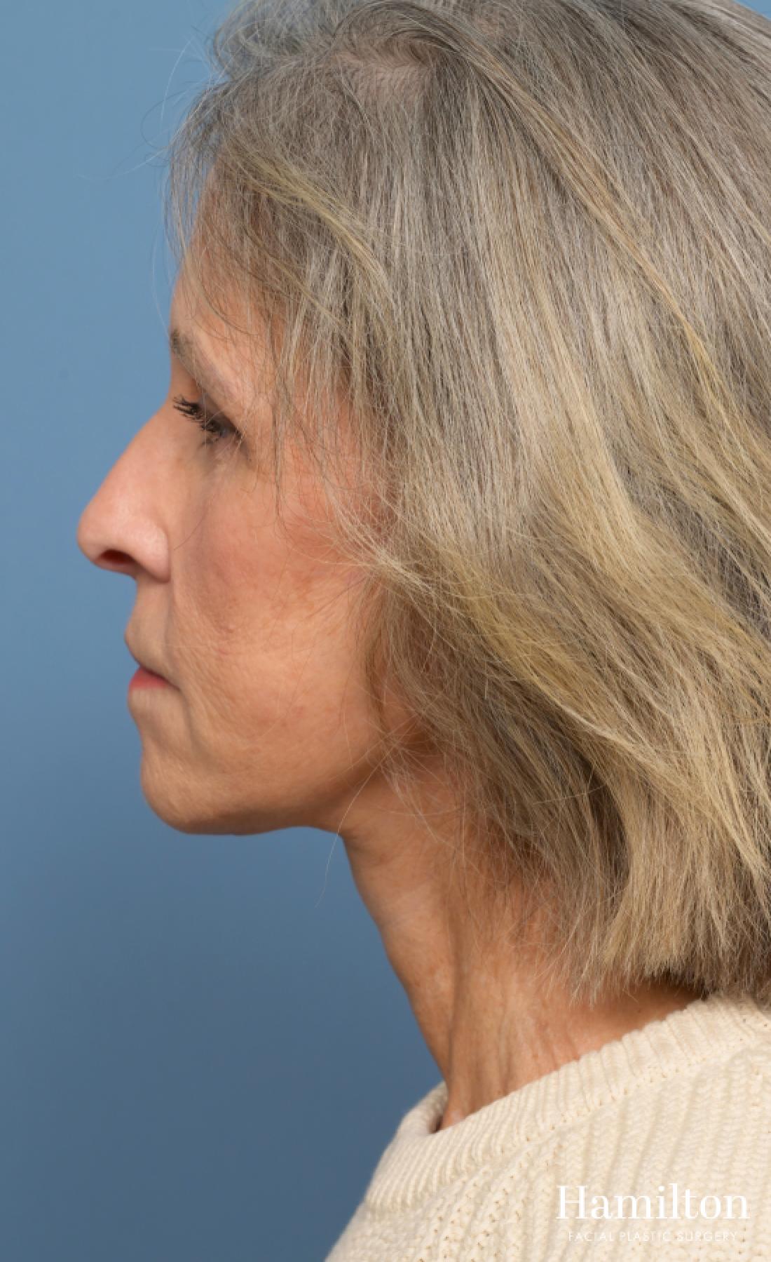 Fat Grafting: Patient 1 - After 5