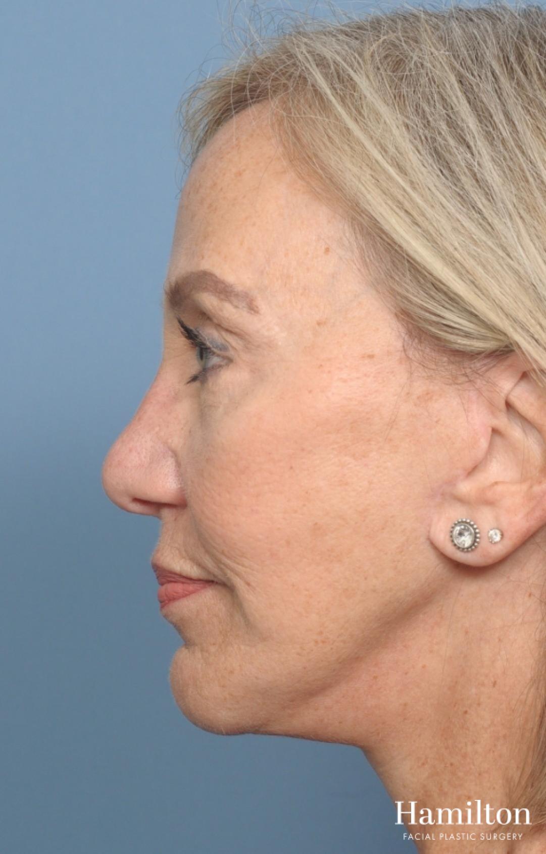 Mini Facelift: Patient 1 - After  