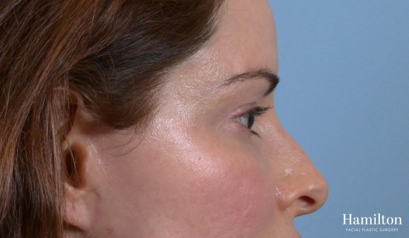 Blepharoplasty: Patient 6 - After 5